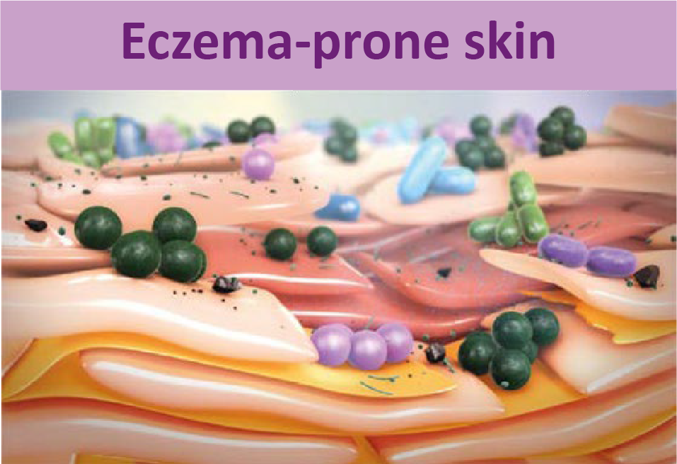 Eczema-prone skin